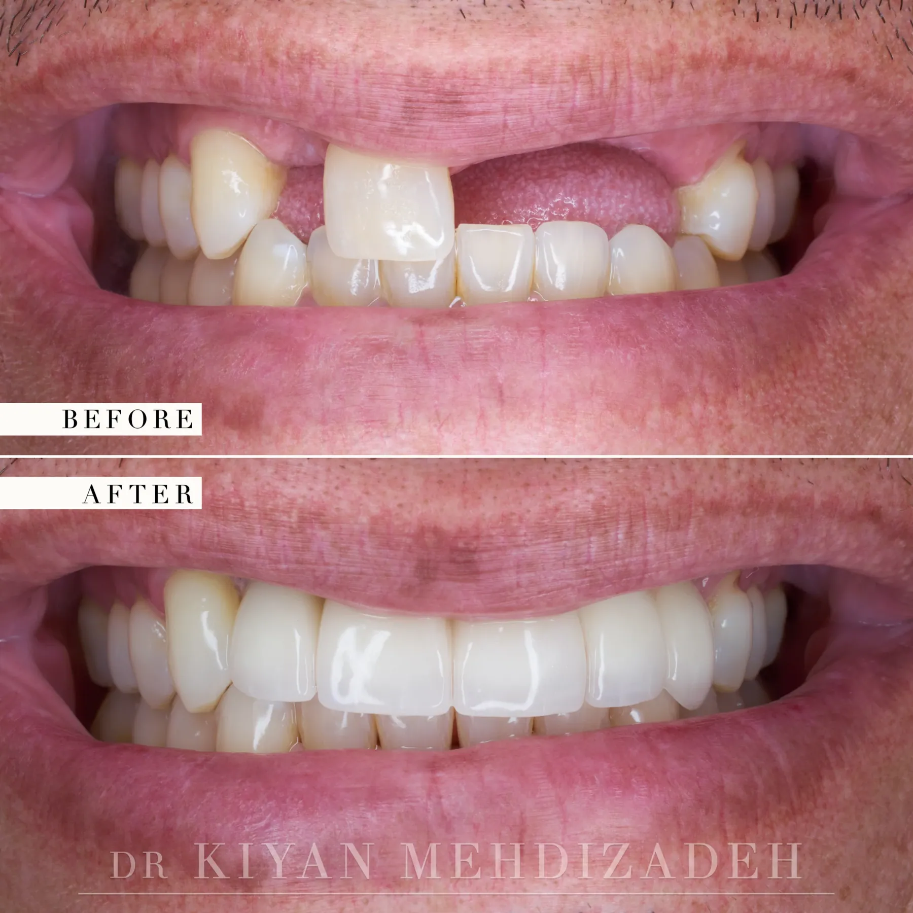 Bone graft and anterior implants before and after &mdash; Case Study 34