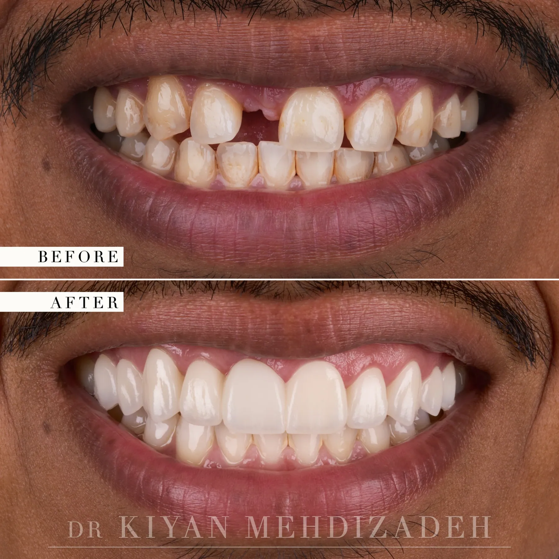 Missing front tooth replaced with a bridge and veneers, before and after, by Kiyan Mehdizadeh, DMD in Beverly Hills