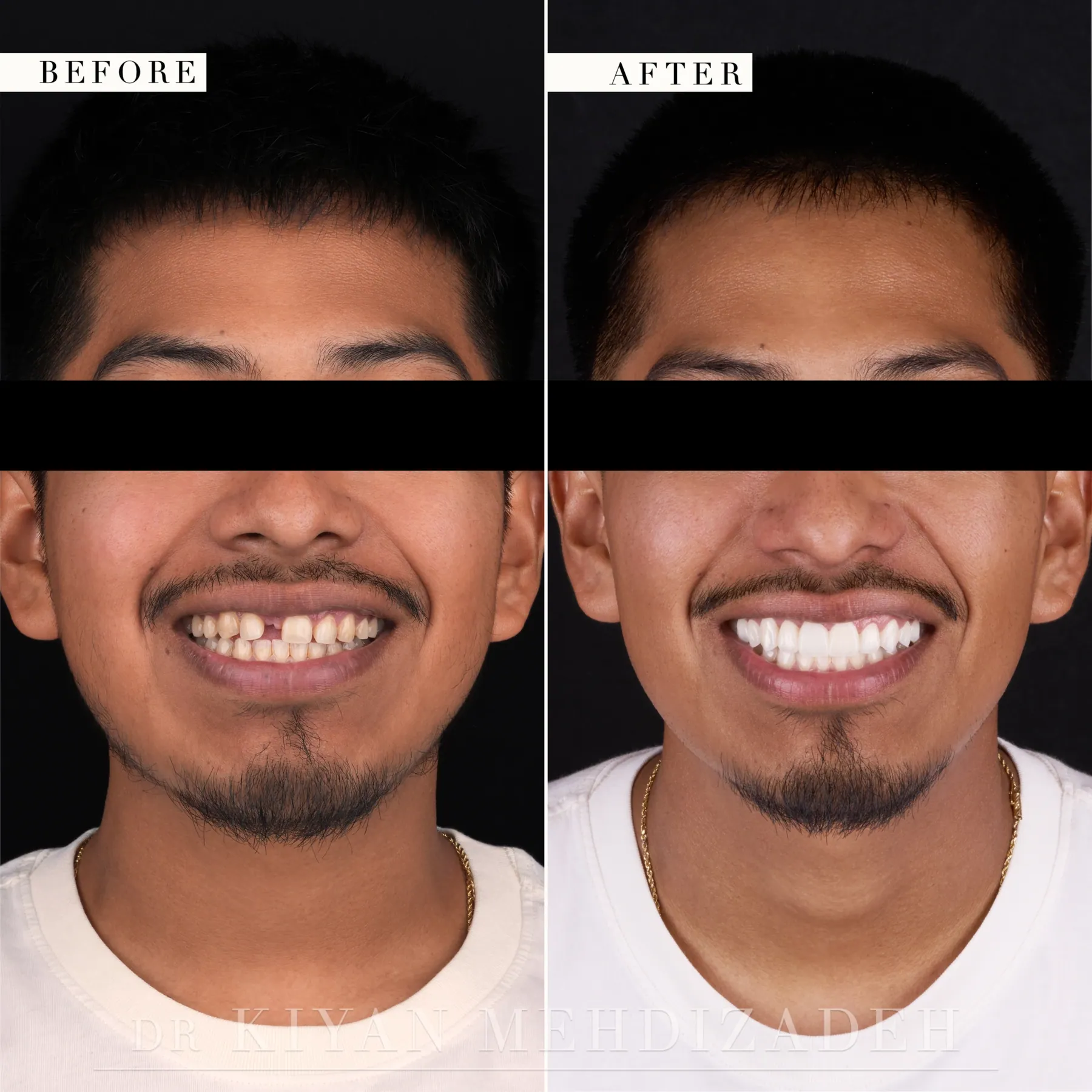 Retrato de rostro completo después de restaurar un diente frontal ausente con un puente y carillas, Beverly Hills