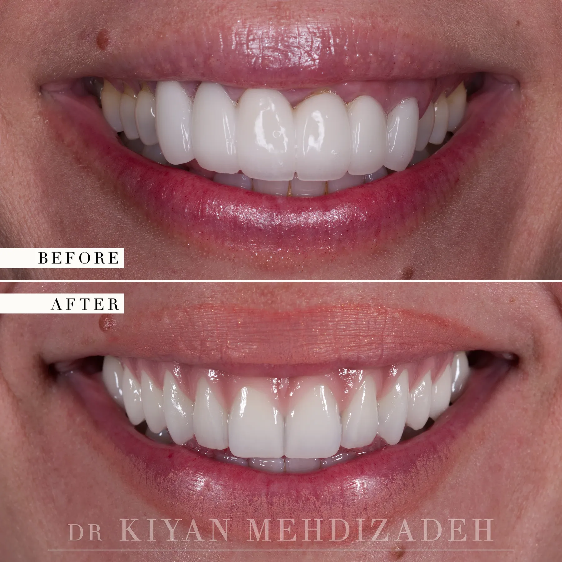 All-on-4 dental implants before and after &mdash; Case Study 05