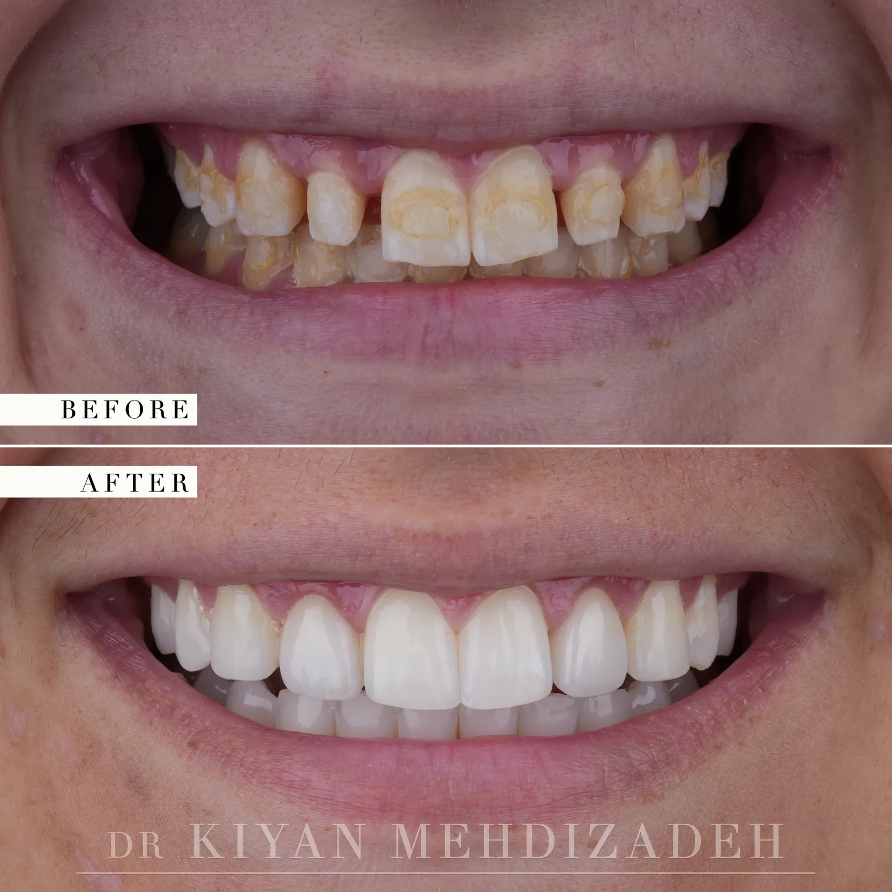 Conservative veneers for peg lateral incisors before and after &mdash; Case Study 12