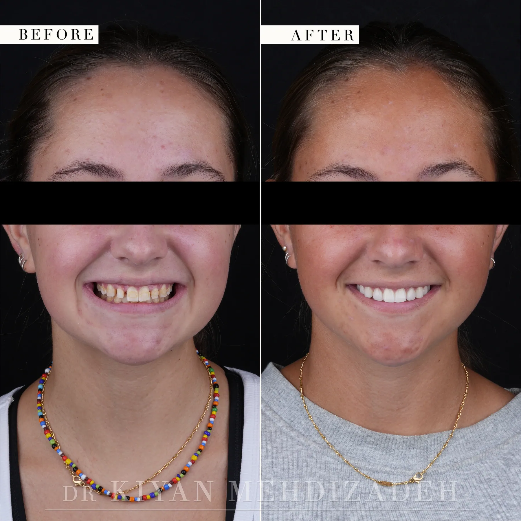 Full-face before and after, peg lateral incisors treated with two veneers