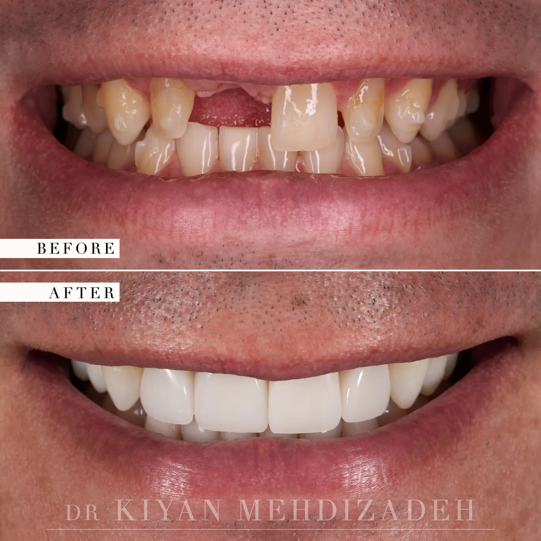 Peg laterals and a front tooth implant before and after &mdash; Case Study 38
