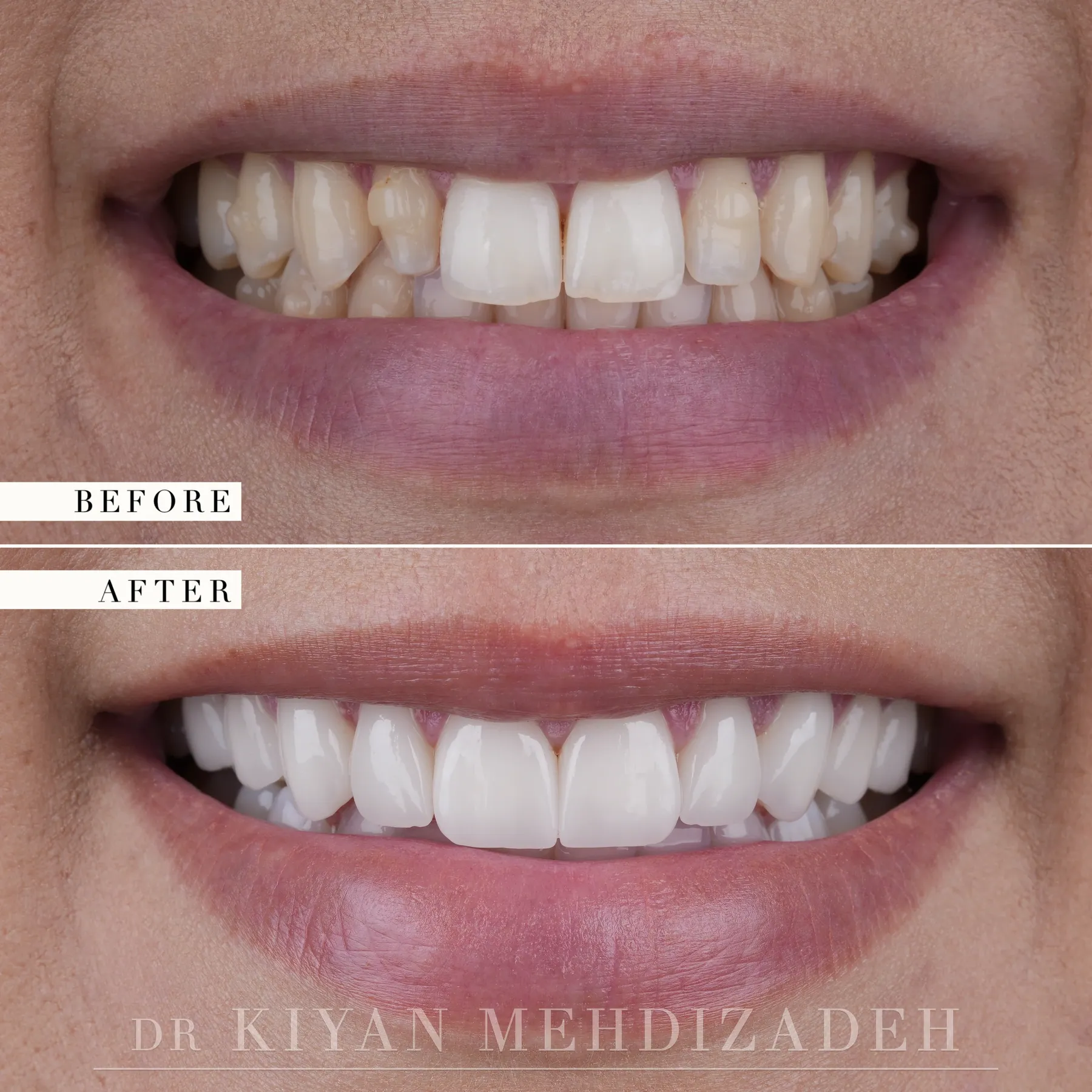 Porcelain veneers for small lateral incisors before and after &mdash; Case Study 07