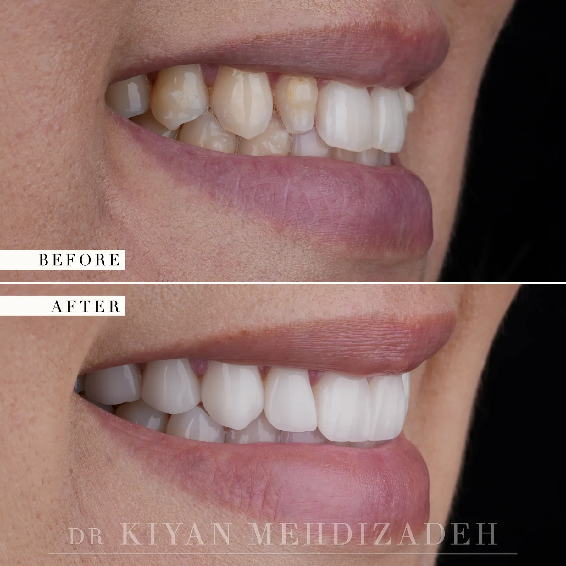 Side view after porcelain veneers widened small lateral incisors