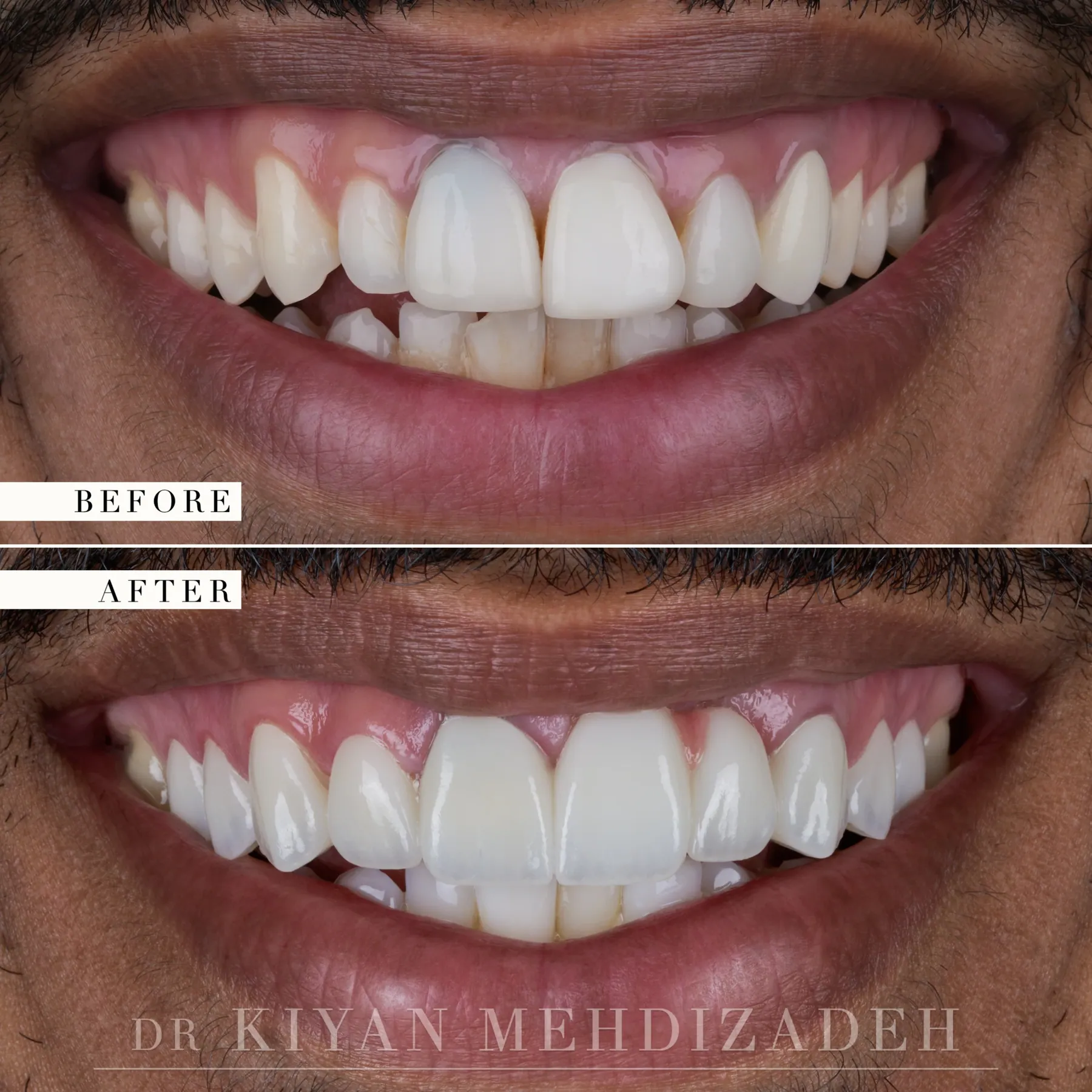 Pink Porcelain Bridge & Veneers before and after - Case Study 19 - Kiyan Mehdizadeh, DMD