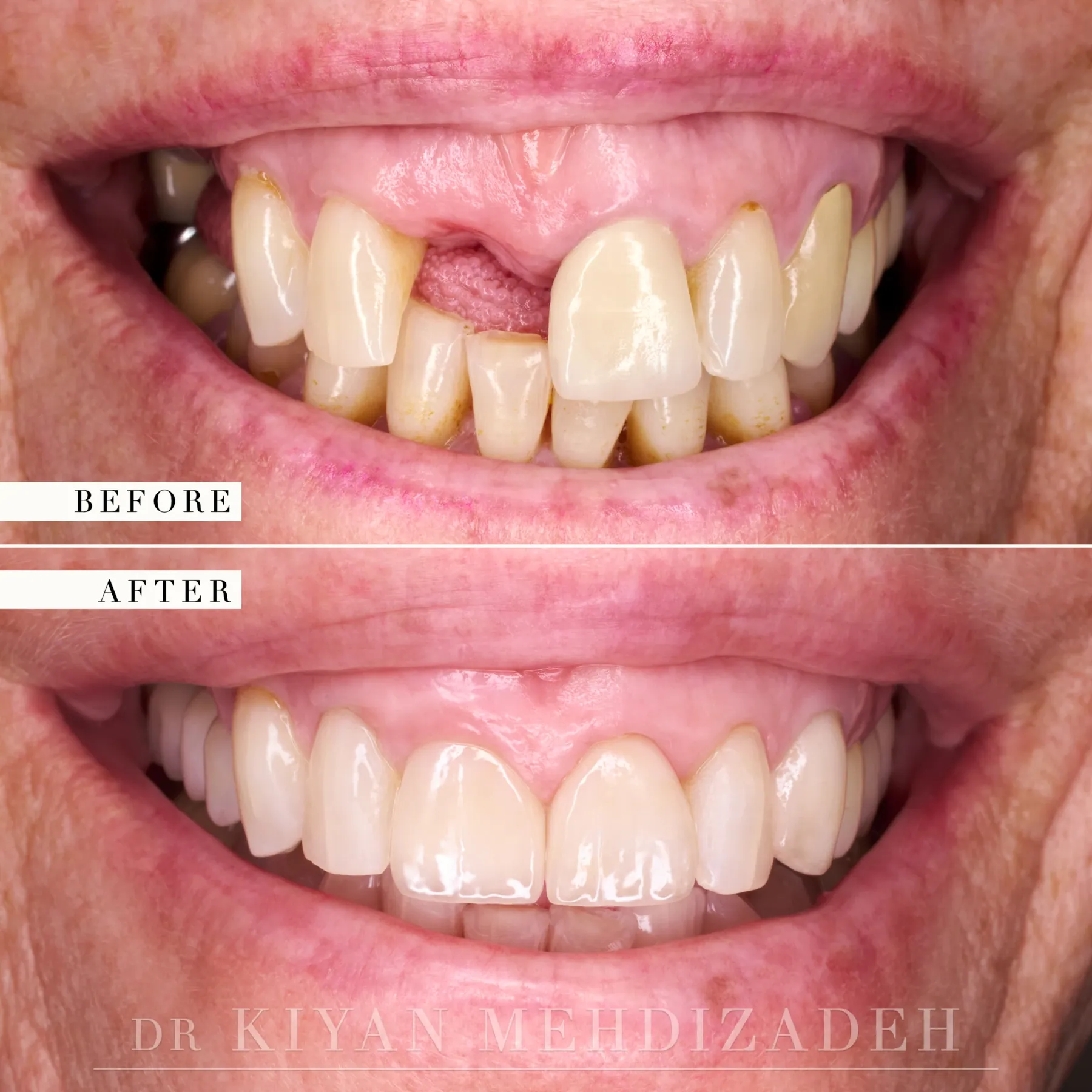 Implant crowns with tissue conditioning before and after &mdash; Case Study 35