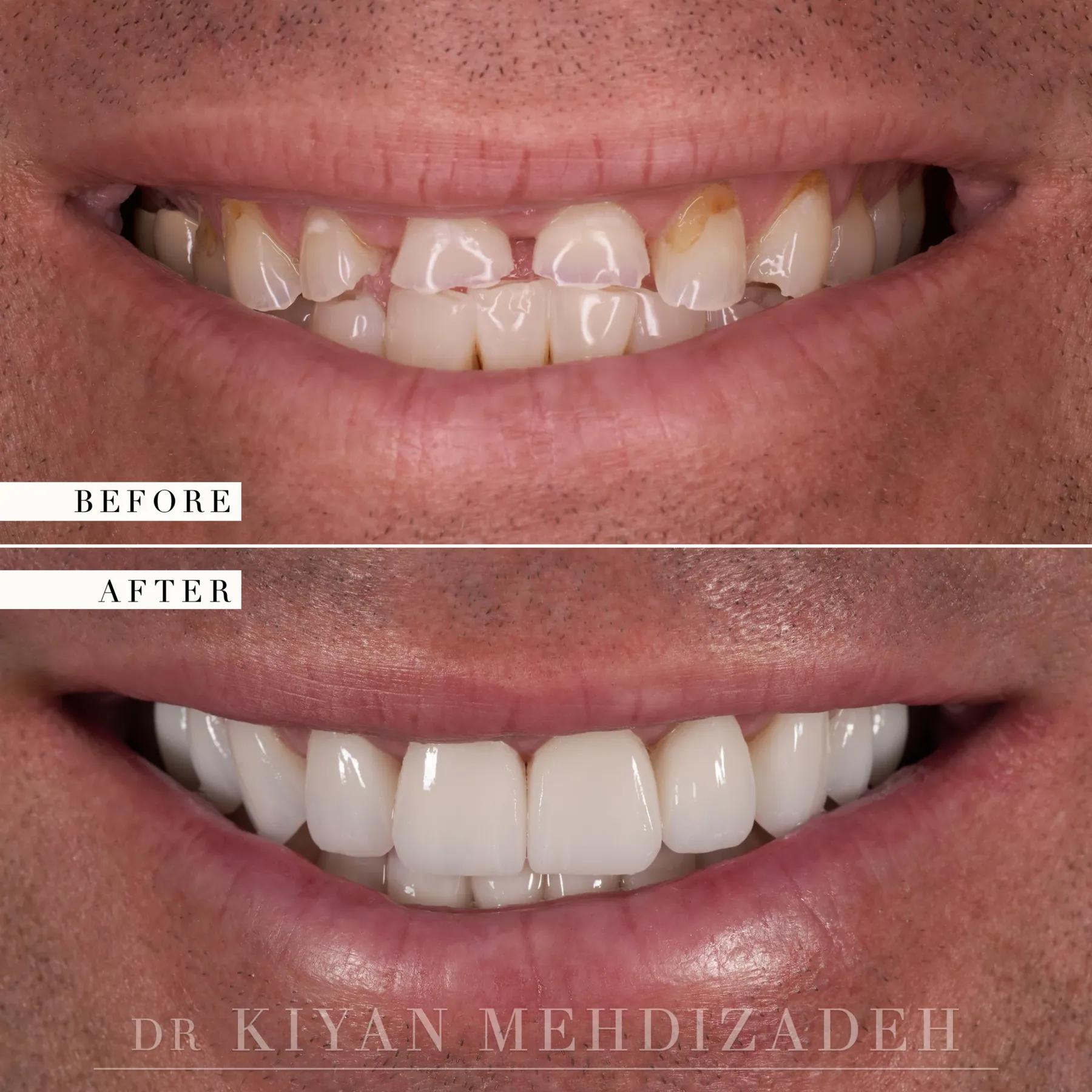 Full mouth reconstruction of worn teeth before and after &mdash; Case Study 33