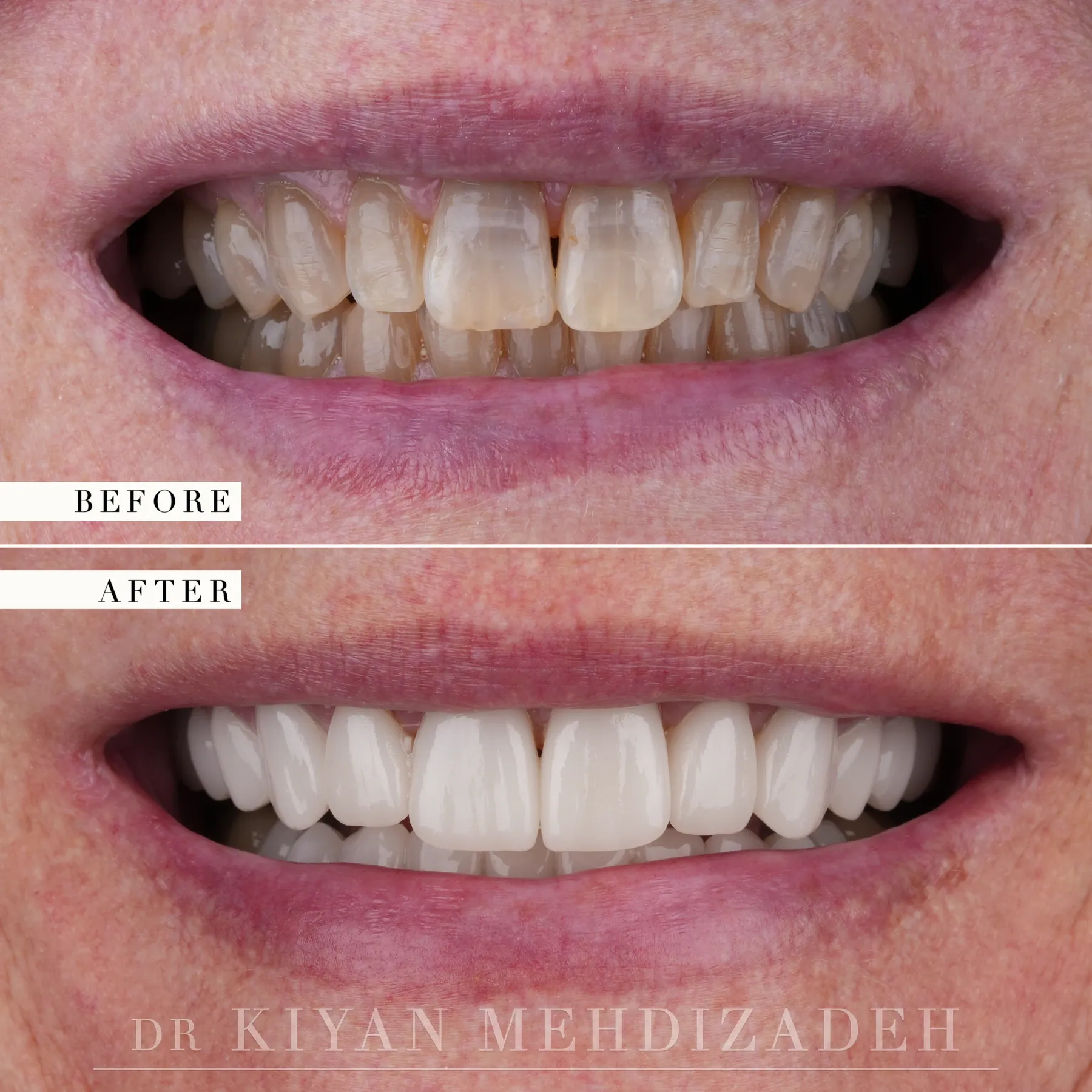 Tetracycline staining correction with porcelain veneers before and after &mdash; Case Study 09