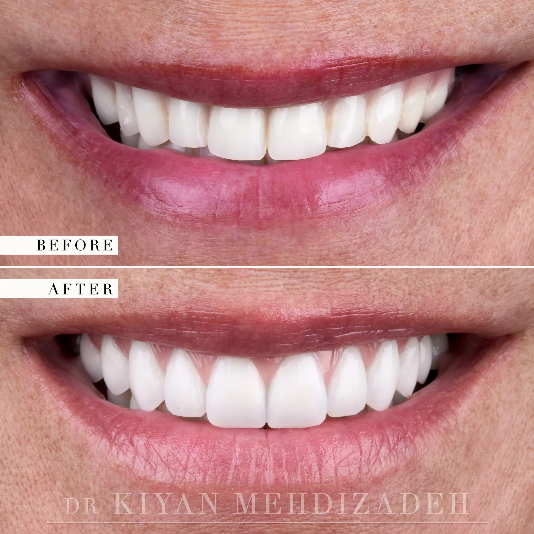 Before and after an upper implant bridge with pink porcelain - close-up of the smile, Beverly Hills