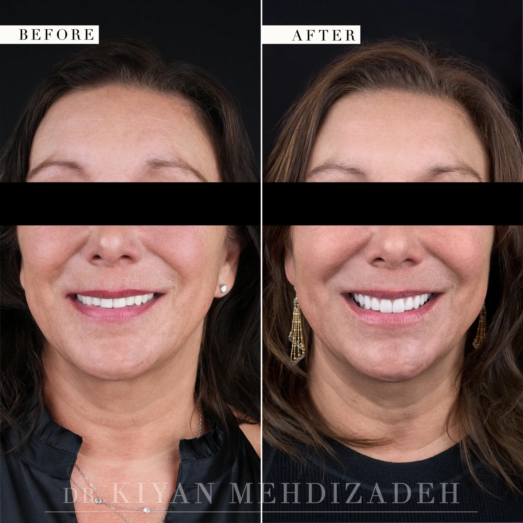 Before and after full-face portrait, eyes redacted - upper implant bridge in hand-stacked porcelain, Beverly Hills