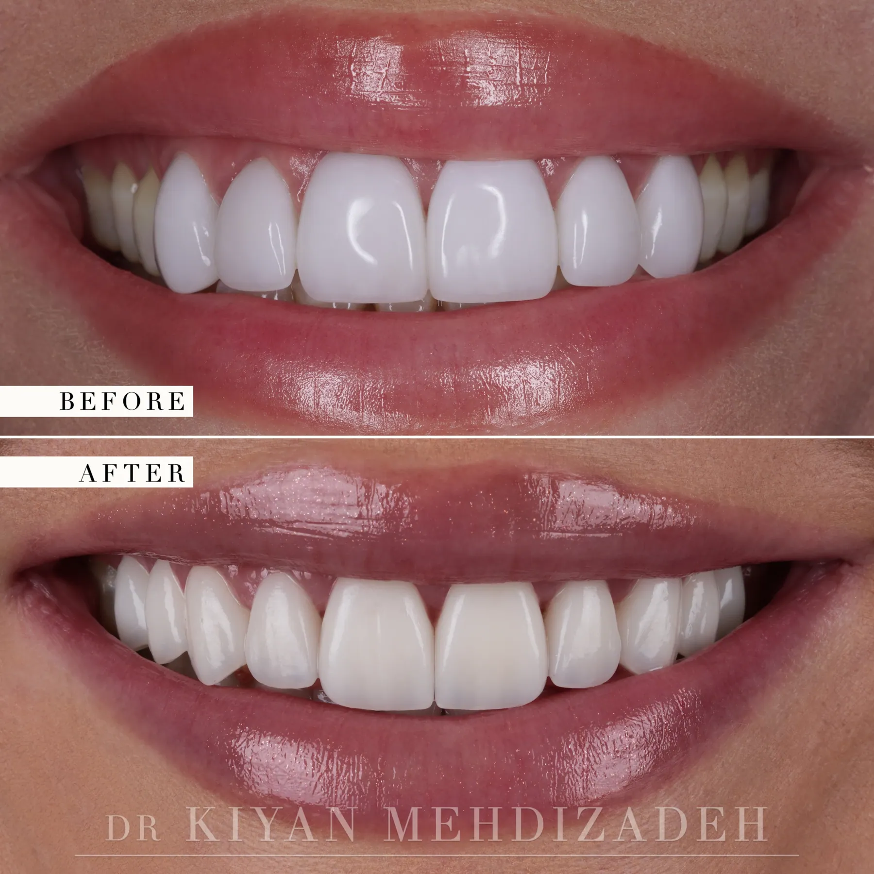 Before and after porcelain veneer replacement: opaque gray-white veneers replaced with natural-looking porcelain