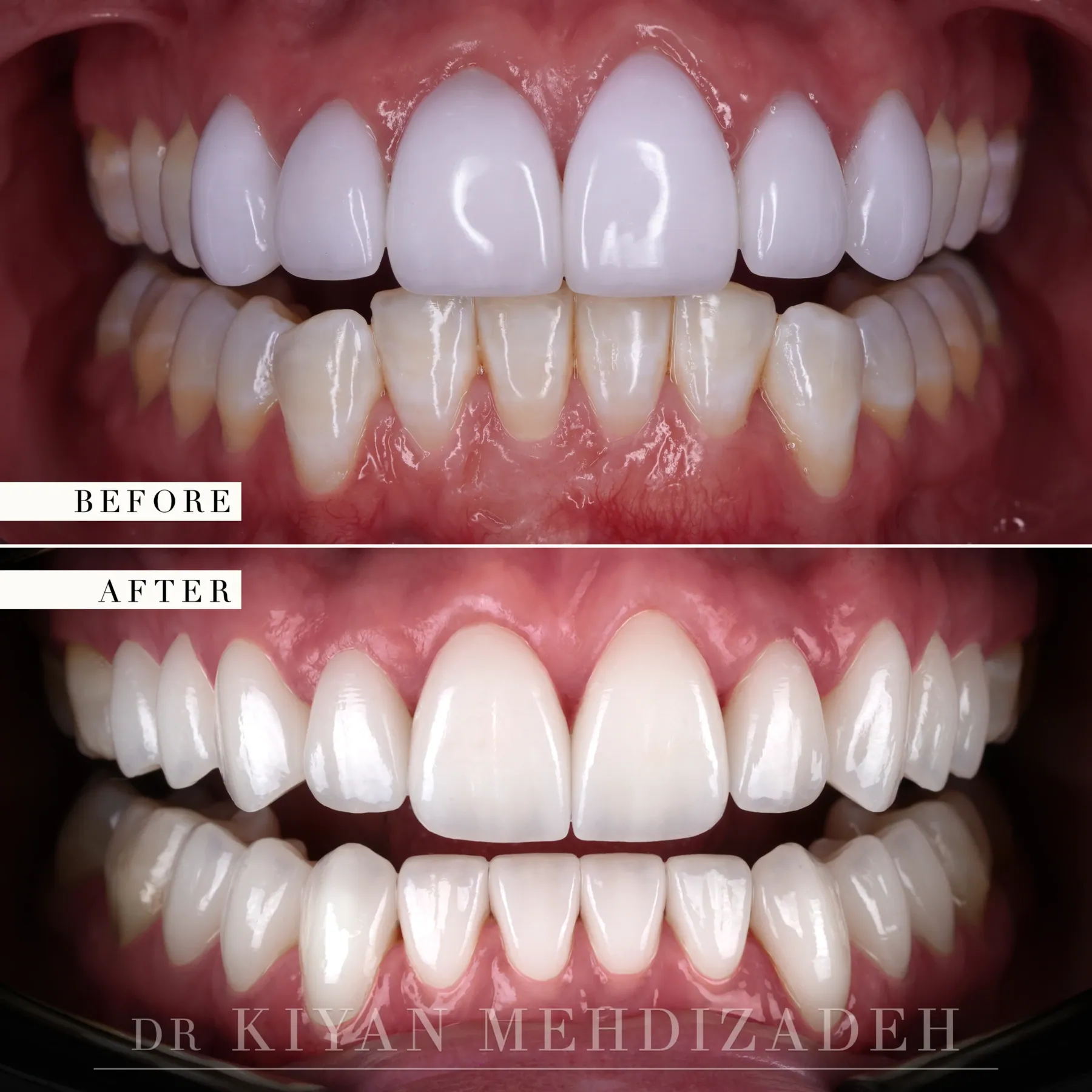 Retracted close-up before and after veneer replacement showing translucency and edge detail of the new veneers