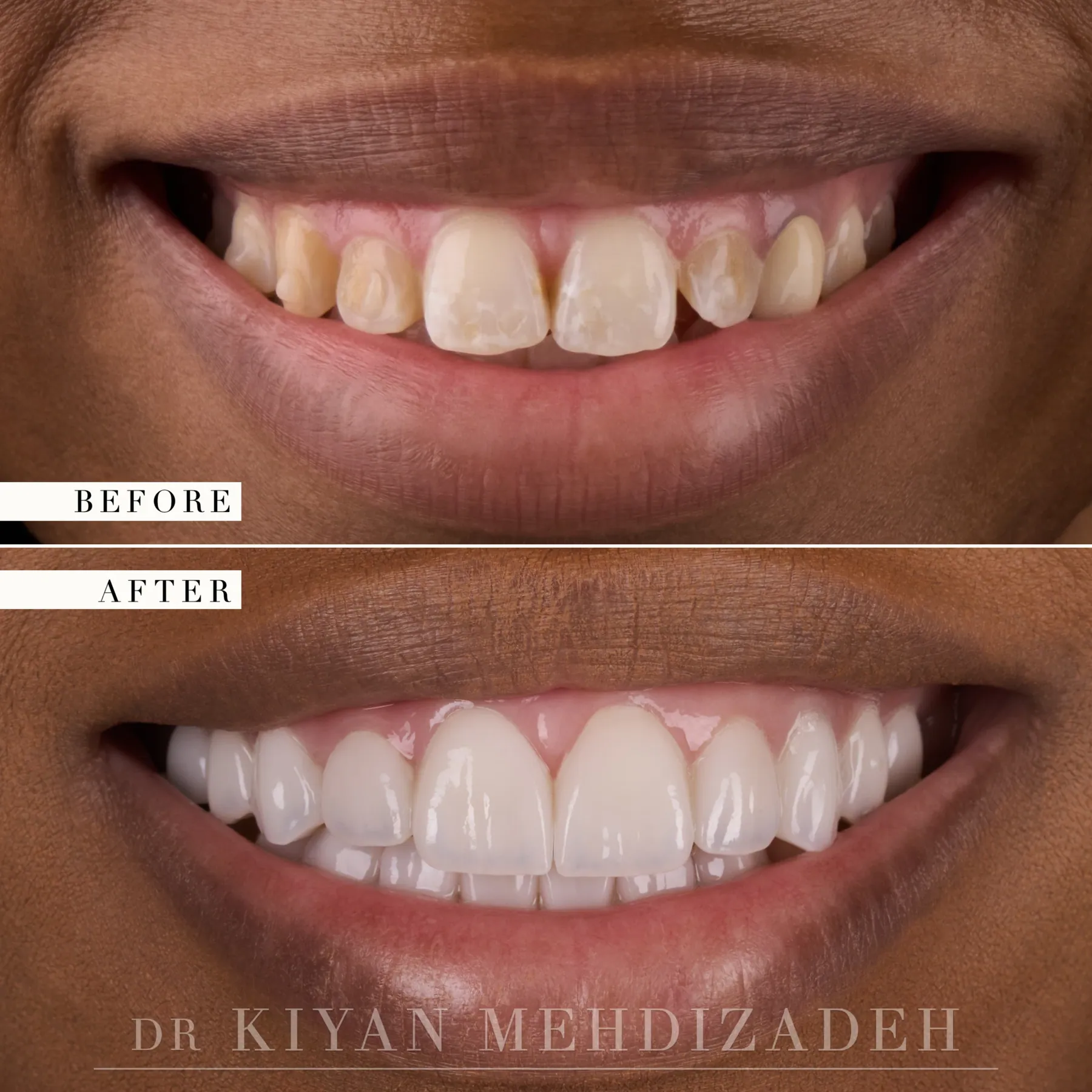 Flaring & Discoloration: Veneers & Onlays before and after - Case Study 25 - Kiyan Mehdizadeh, DMD