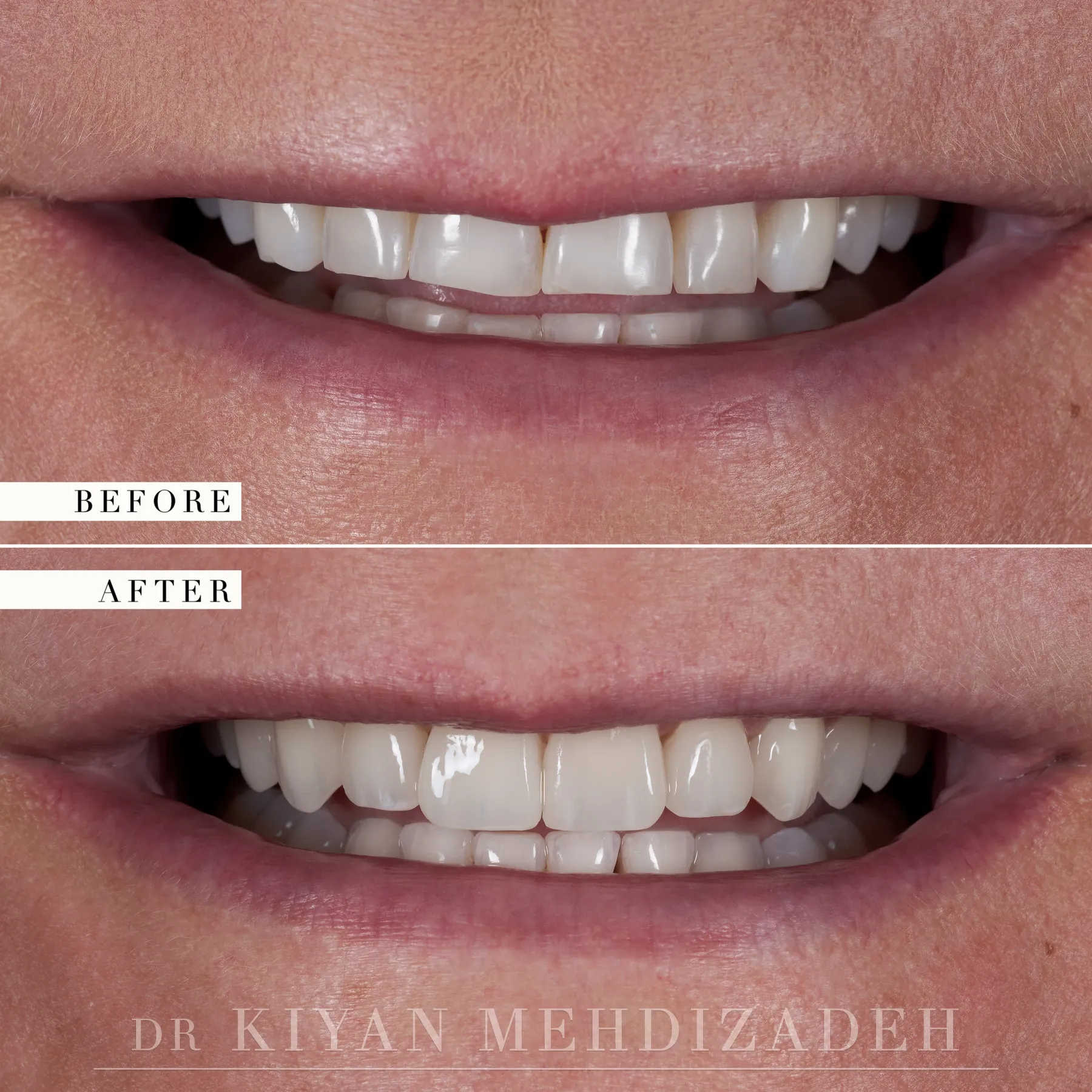 Veneers for teeth worn by grinding before and after &mdash; Case Study 51