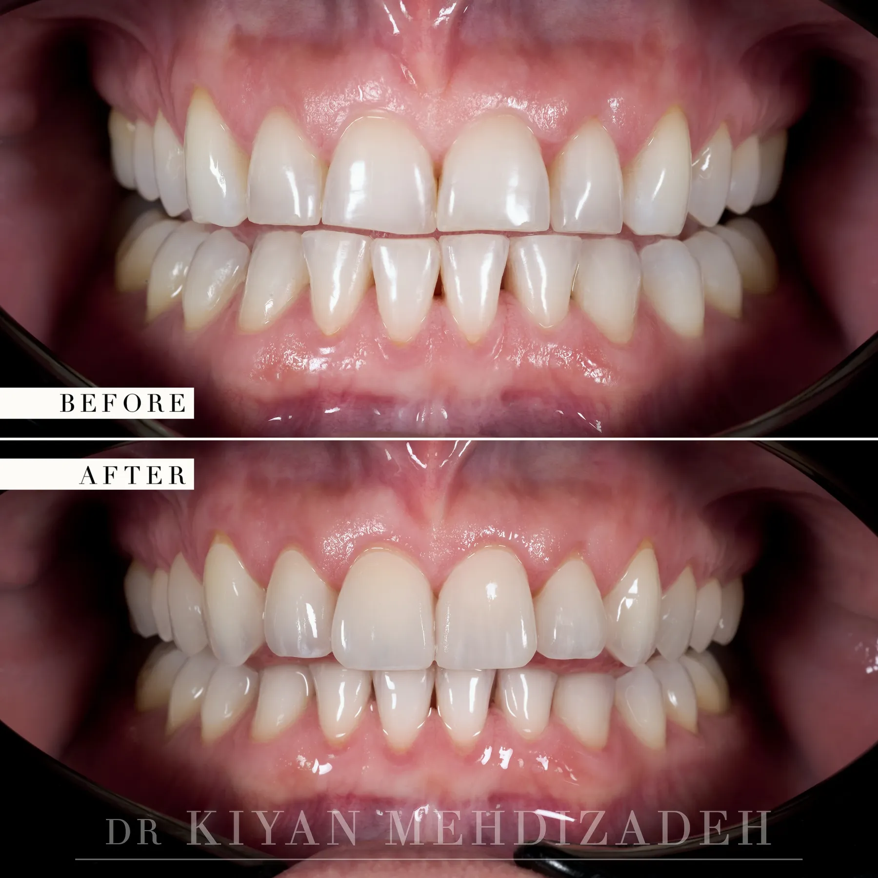 Before and after veneers and onlays for grinding wear - retracted view with the teeth together, restored length and bite