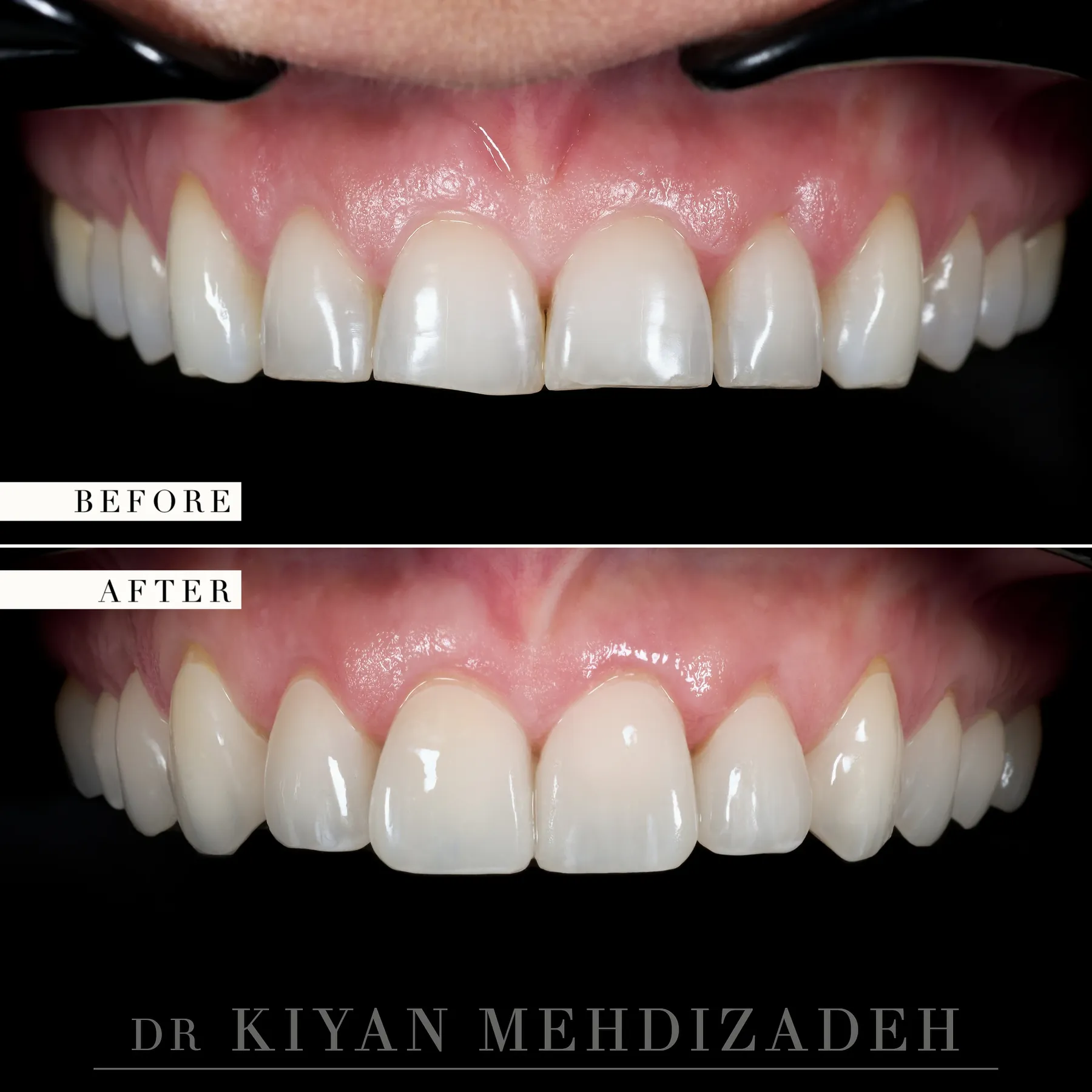 Before and after e.max veneers for worn upper teeth - retracted view of the upper arch