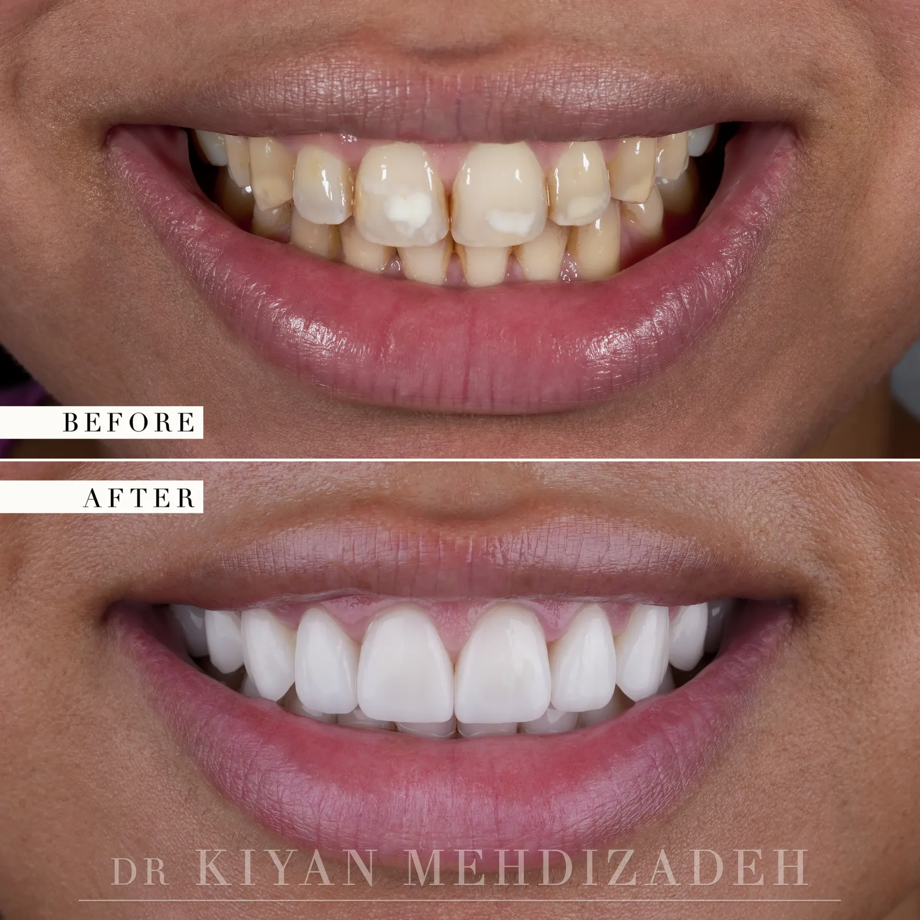Porcelain veneers for congenital discoloration before and after &mdash; Case Study 50