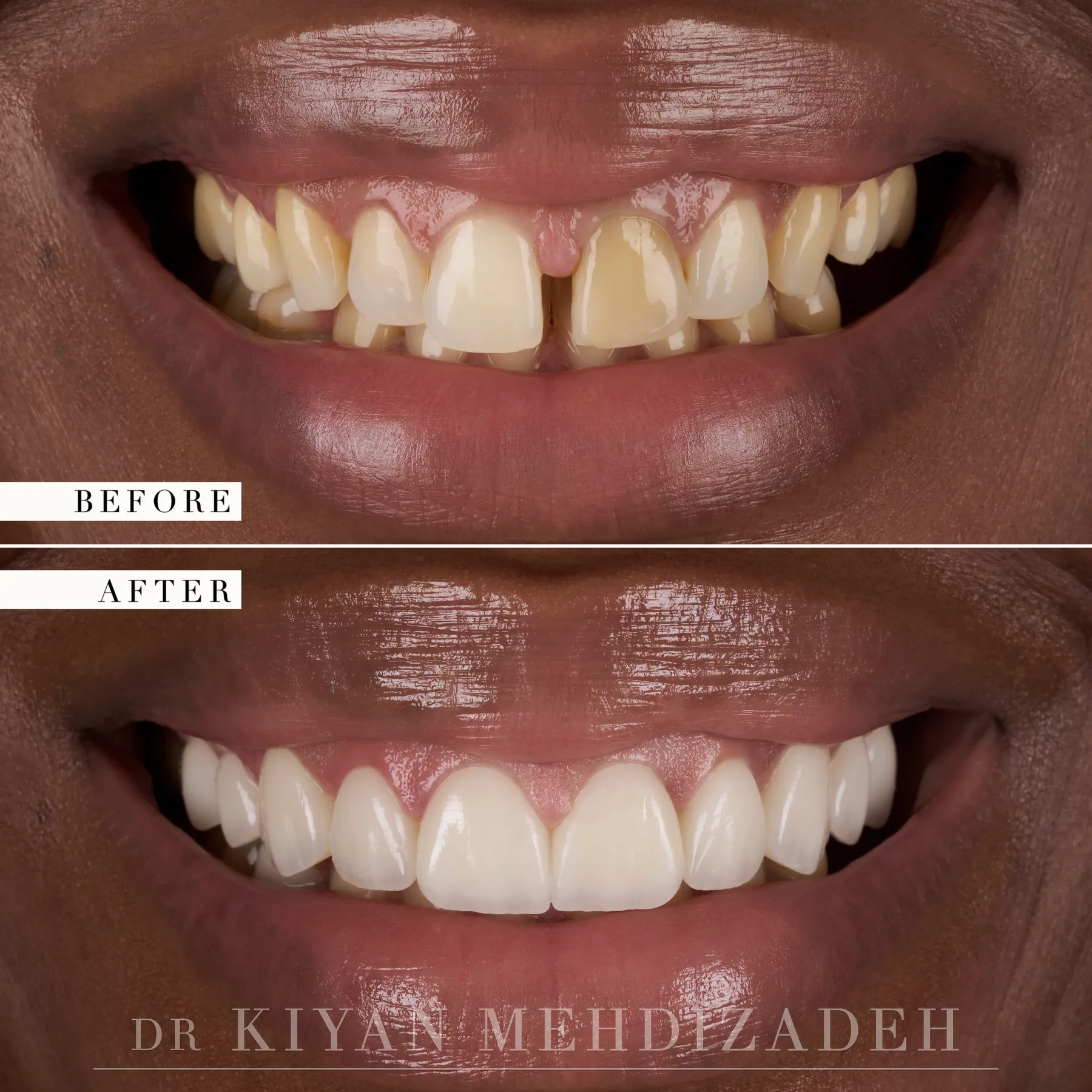 Gap Closure & Discoloration: Veneers before and after - Case Study 22 - Kiyan Mehdizadeh, DMD