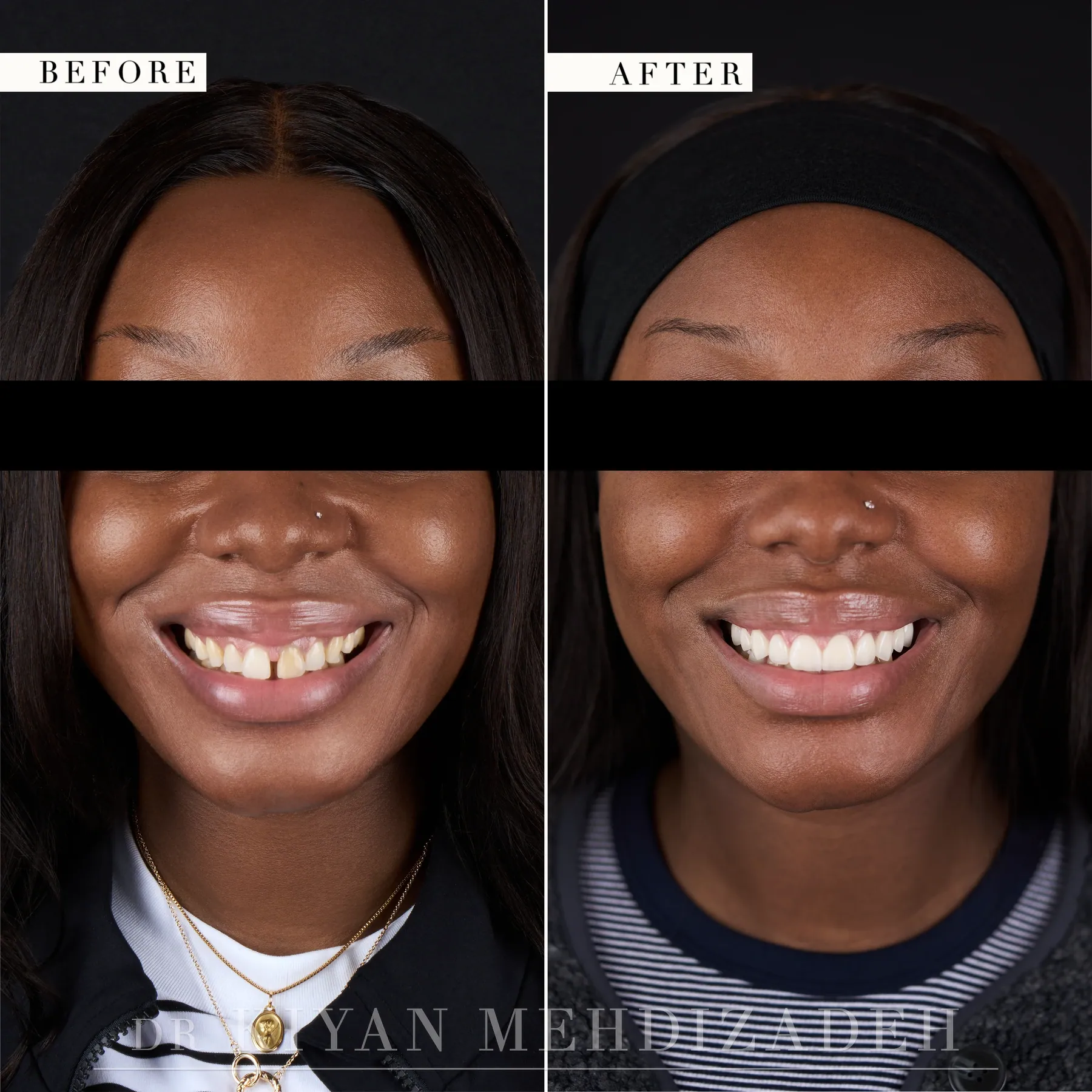 Full-face before and after, gap closed with porcelain veneers