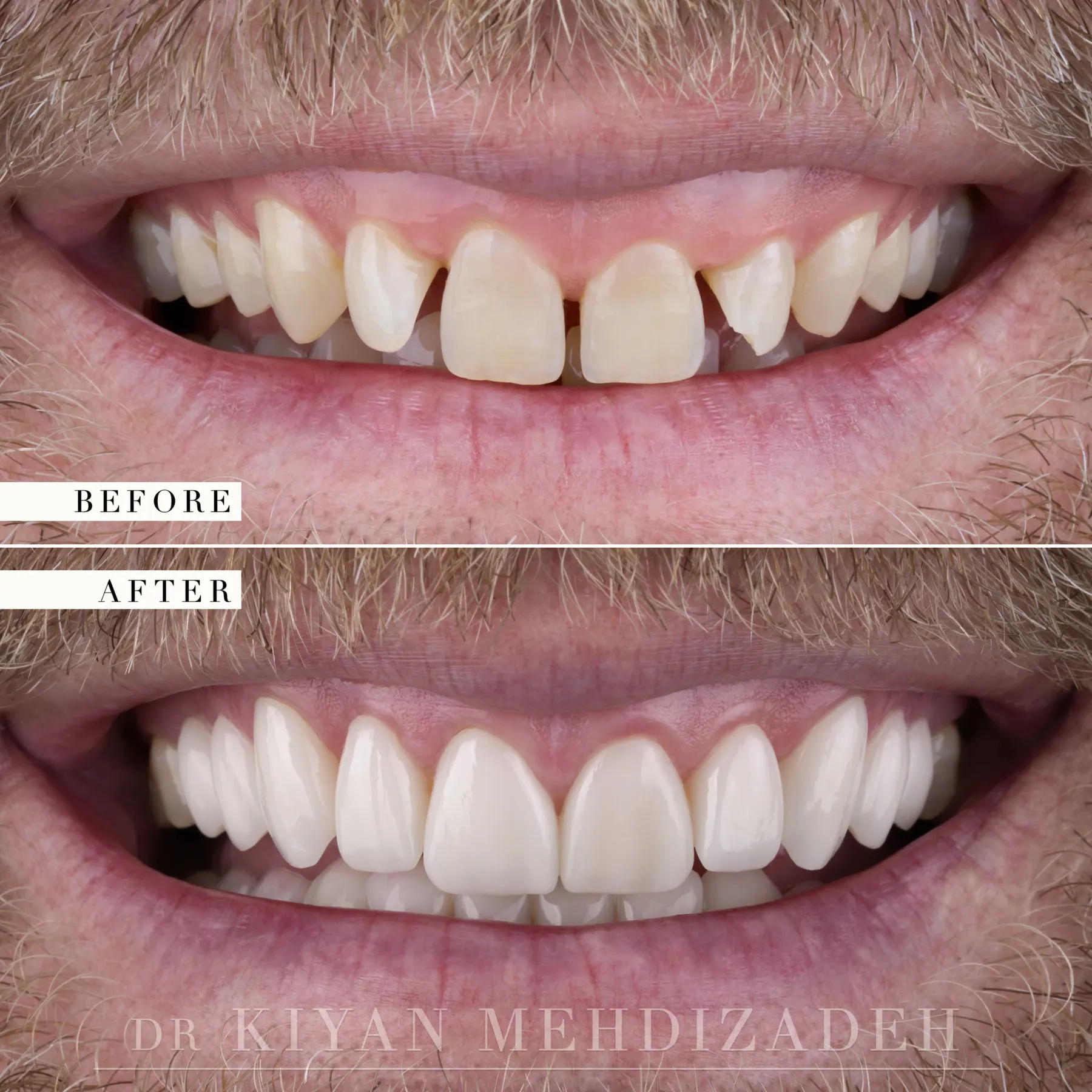 Peg Laterals: Crown Lengthening & Veneers before and after - Case Study 28 - Kiyan Mehdizadeh, DMD