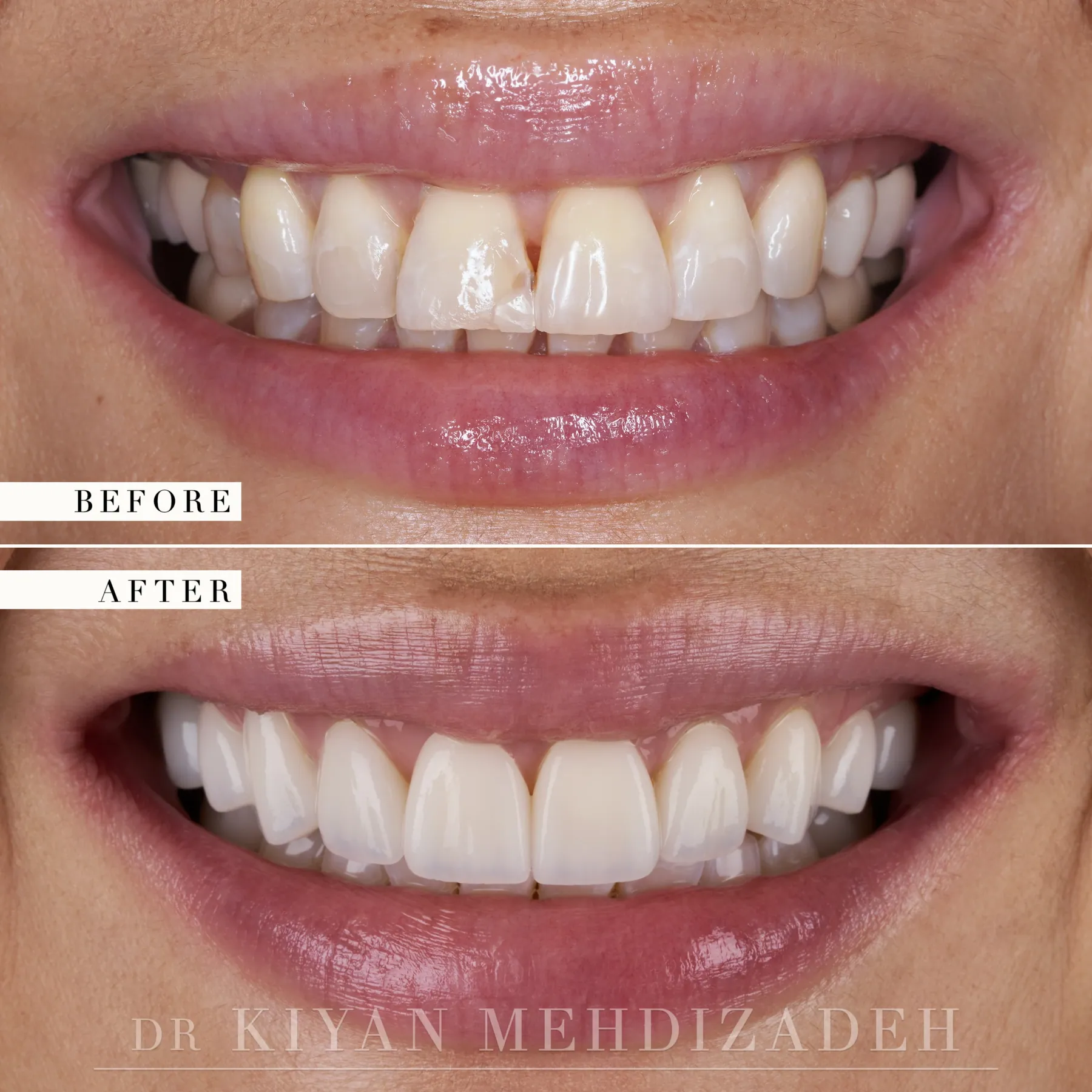 Chipped tooth and old bonding replaced with veneers, before and after, Beverly Hills