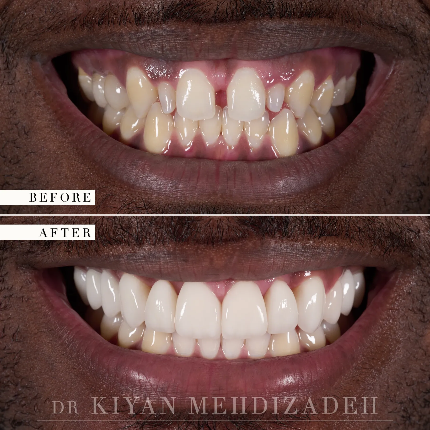 Peg laterals lengthened and a diastema closed before and after &mdash; Case Study 44