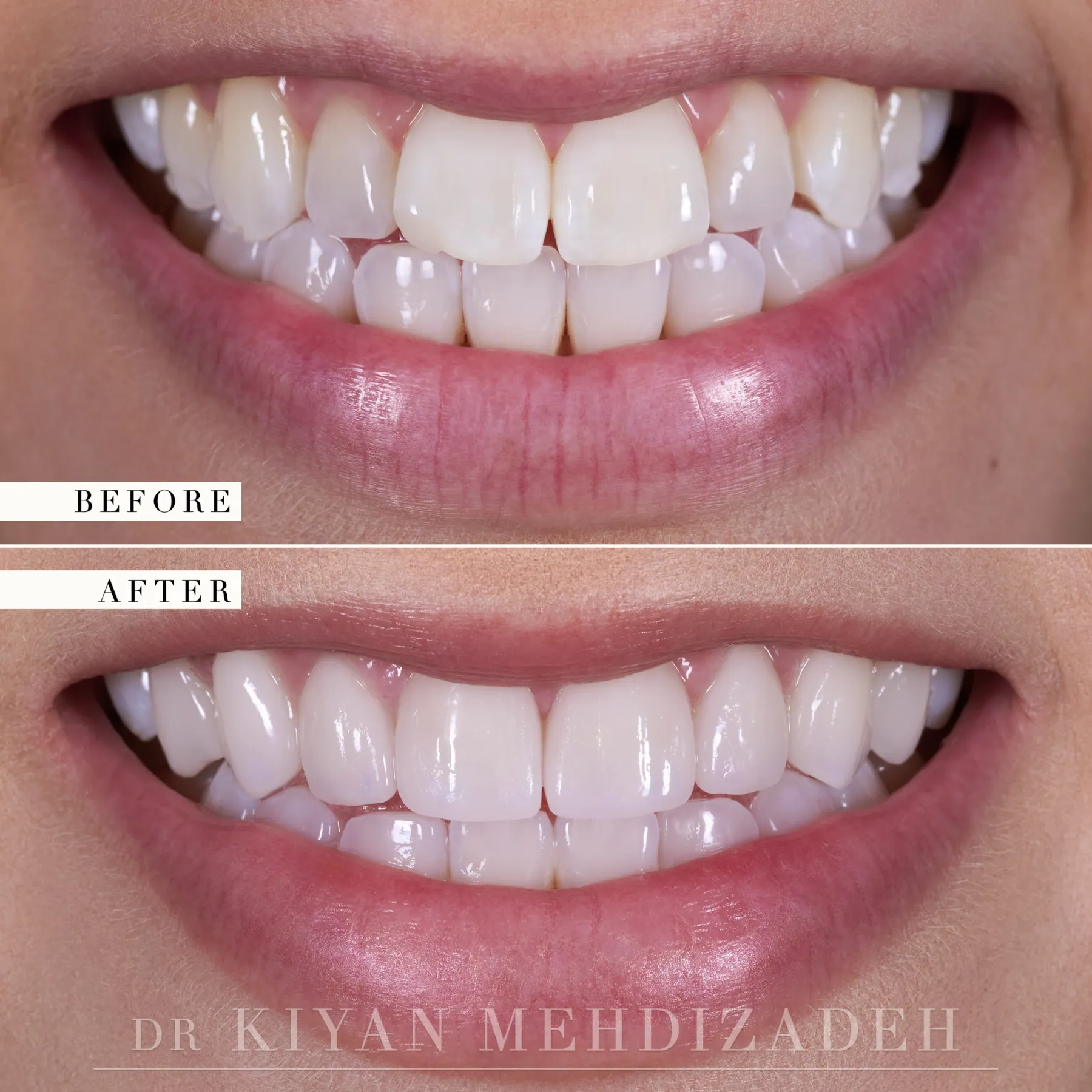 Underbite: Veneers Within the Bite before and after - Case Study 30 - Kiyan Mehdizadeh, DMD